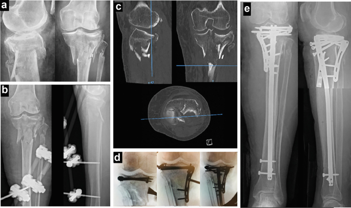 Distal humeral plating of an intramedullary nail periprosthetic fracture  using a miss-a-nail technique: a case report | Cases Journal | Full Text