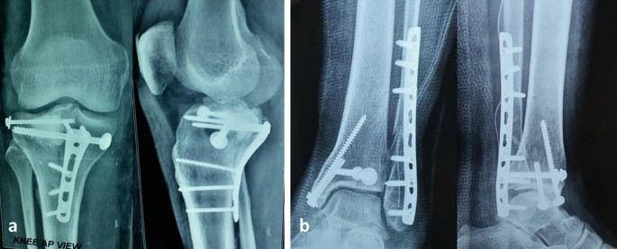 Tibial Pursuit: How to identify and side the tibia