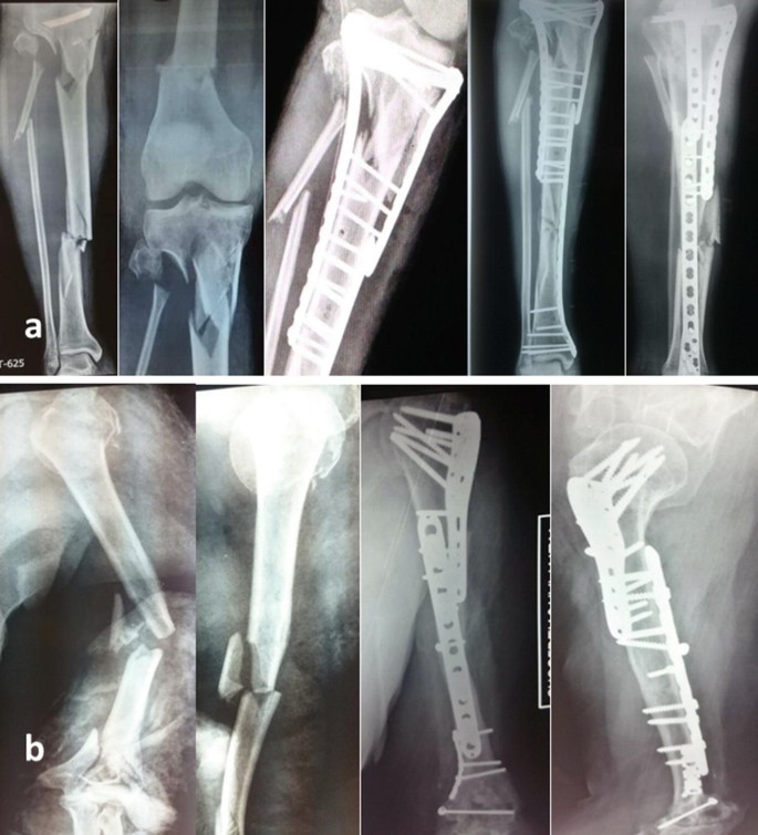 PDF] Functional Outcomes and Quality of Life Following Complex Tibial  Fractures Treated with Circular External Fixation: A Comparison between  Proximal, Midshaft, and Distal Tibial Fractures