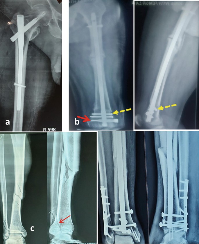 PDF] Functional Outcomes and Quality of Life Following Complex Tibial  Fractures Treated with Circular External Fixation: A Comparison between  Proximal, Midshaft, and Distal Tibial Fractures