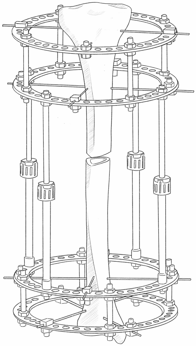 Internal Fixation versus External Fixation in Orthopaedic Trauma ...