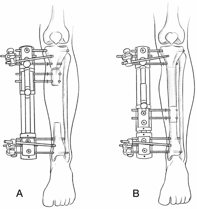 Internal Fixation versus External Fixation in Orthopaedic Trauma ...