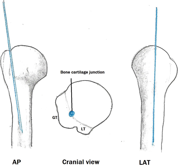Left dissected humerus. In one arm we inserted a T2 humerus nail... |  Download Scientific Diagram