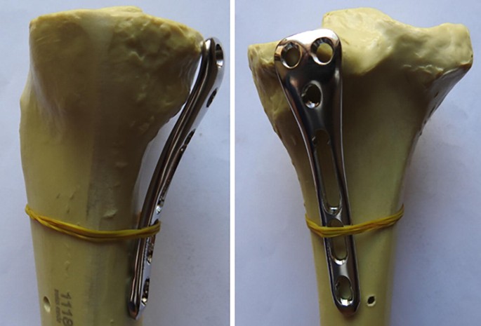 Four ring frame designing with spread along entire length of tibia