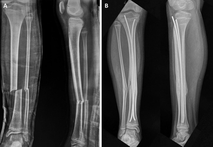 Orthopedic Follow-Up Evaluations: Identifying Complications