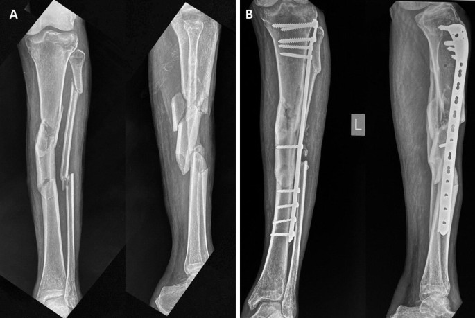 Functional Outcome of Intramedullary Interlocking Nail and Plate Fixation  in The Surgical Management in Distal Tibia Fracture: A Comparative Study |  Telang | International Journal of Orthopaedics