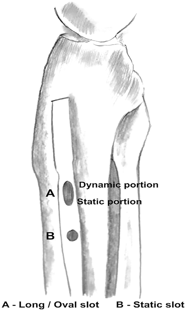 DAKSH Proximal Femoral Nail with Helical Blade - ORTHO CARE