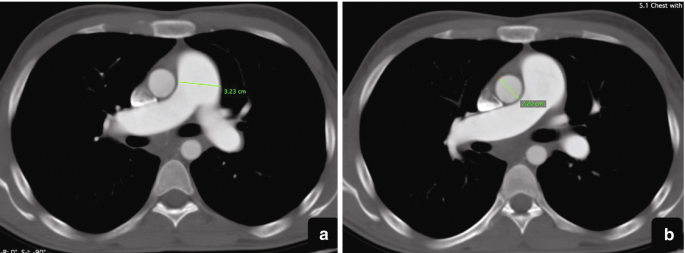 Egg and banana sign (pulmonary hypertension), Radiology Reference Article
