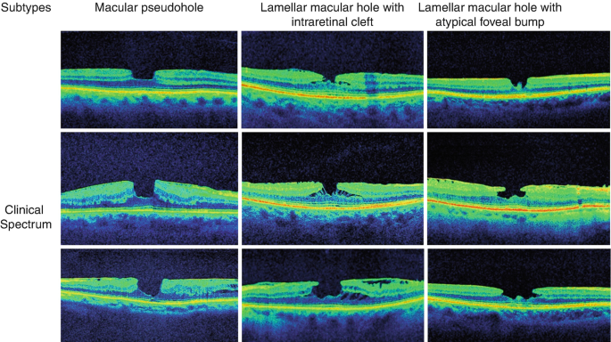 Lamellar Macular Hole: Ultrastructural Analysis, Surgical Outcomes, and  Visual Prognosis | SpringerLink