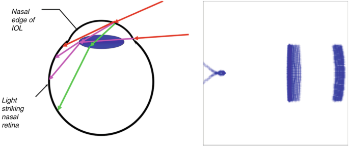 CTR's – PMMA Capsular Tension Rings » IMT