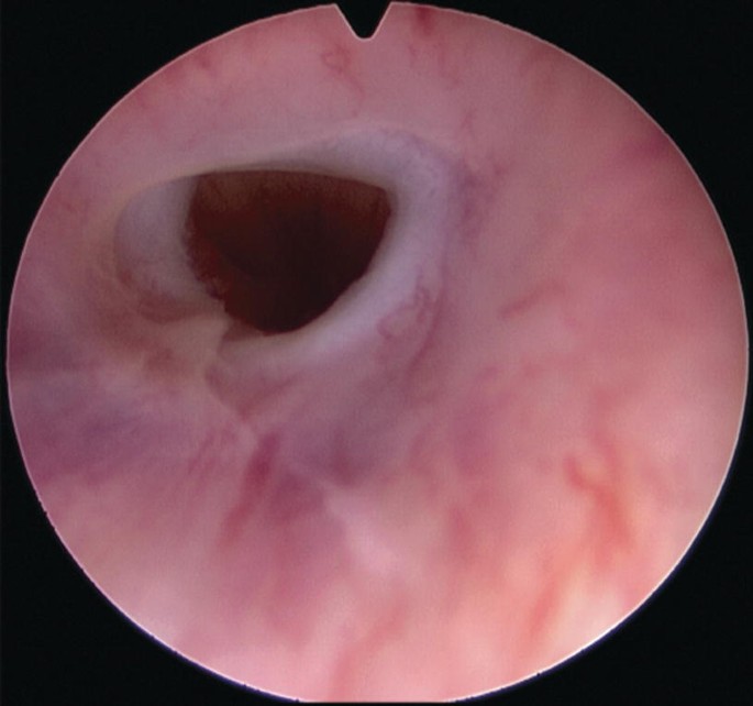 Female Anastomotic Urethroplasty