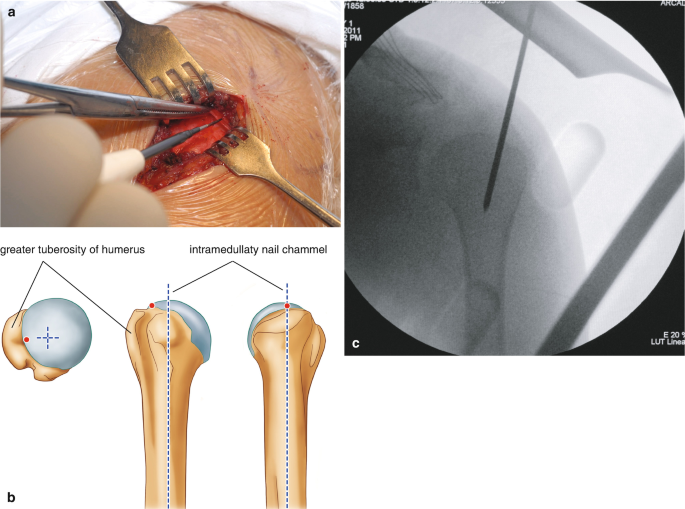 View of Over-Reaming the Humerus to Place an IM Lengthening Nail | Journal  of the Pediatric Orthopaedic Society of North America