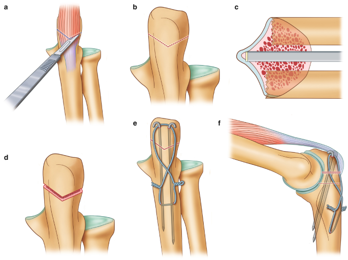 Fracture of the Distal Humerus | SpringerLink