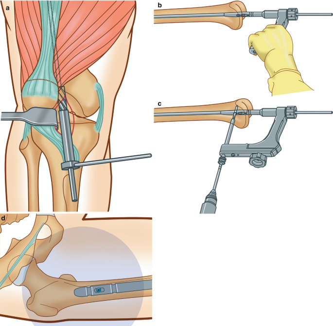 4 illustrations of the full-circle technique for the placement of screws. (a) exhibits the reaming of the medullary cavity along the guide wire's direction. (b) represents the insertion of a nail into the medullary cavity with bare hands and tapping. (c) explains distal locking. (d) exhibits locking of the proximal end with screws.