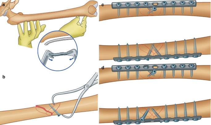 4 diagrams illustrate the use of lag screws and protective plates to repair B 1 and B 2 fractures. (a) The pre-shaping of the plate according to the shape of the femur. (b) The reduction of the butterfly fragment and fixation with a lag screw. (c) and (d) Exhibit the fixation of the fracture with bicortical screws on both sides.