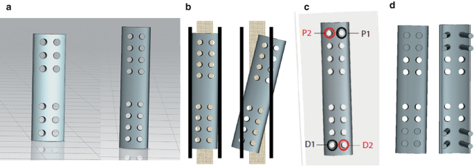 4 schematic illustration of the process of the multidimensional cross-locking plate. (a) Exhibits M D C L P consisting of 6 and 8 holes. (b) Placement of plate. (c) Describes fixation of the first choice of 2 holes in a diagonal pattern. (d) Defines the fixation of bicortical screws around the nonunion site.