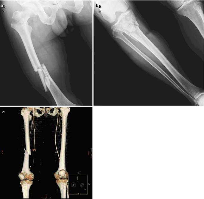 3 radiographs of a patient with multiple injuries. (a) and (b) x-rays indicate a fracture of the right femoral shaft, a right intertrochanteric fracture, and a tibial plateau fracture. (c) a 3-D reconstructed C T scan represents a right femoral fracture, absence of the right dorsalis pedis pulse, and superficial femoral artery rupture.