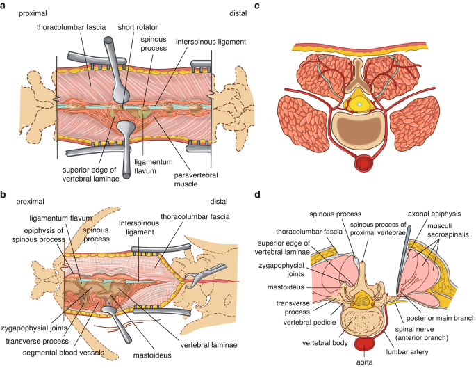 An illustration of incision of thoracolumbar posterior. An incision is done deep into the spine until the vertebral part.