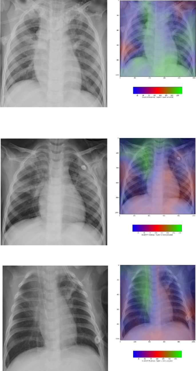 Grad-CAM-Based Classification of Chest X-Ray Images of Pneumonia Patients |  SpringerLink