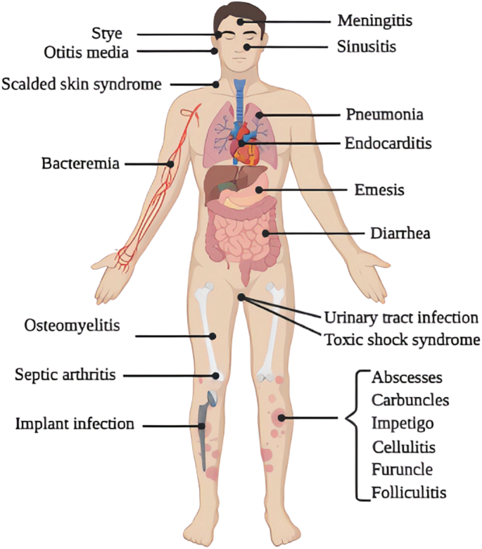 Skin Infections Caused by Staphylococcus aureus, HTML