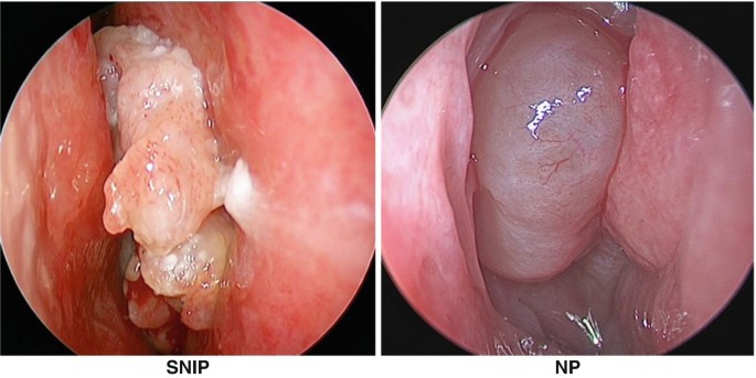 nasal papilloma