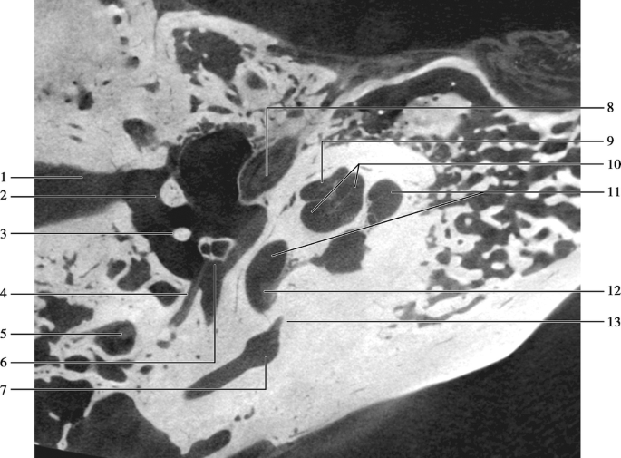 pyramidal eminence ct