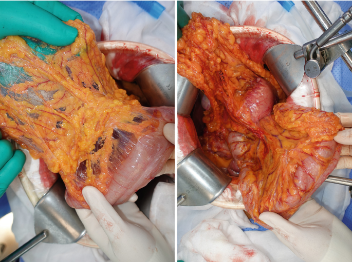 2 photographs of a surgical procedure. They present the fatty tissues during the omentectomy.