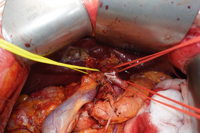 A photograph of a surgical procedure involves the area around the bile duct.