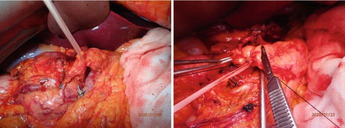 2 photographs of a surgical procedure. They entail dividing the pancreas with surgical instruments and suturing it.