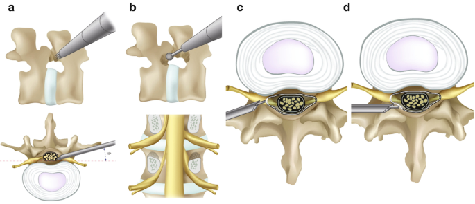 Transforaminal Endoscopic Lumbar Discectomy for Paramedian Disc Herniation with Ho:Yag Laser | SpringerLink