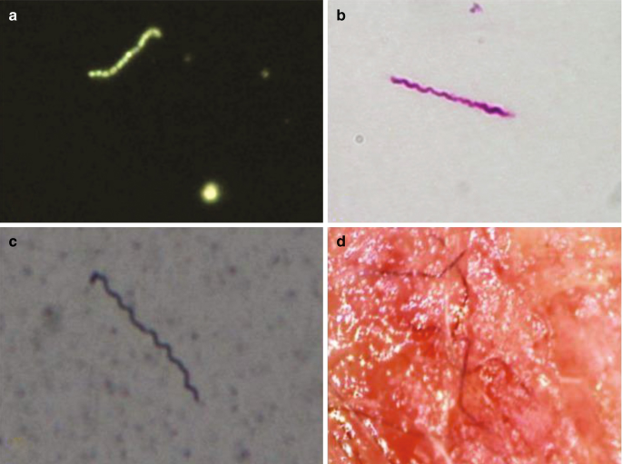 Lyme Disease | SpringerLink