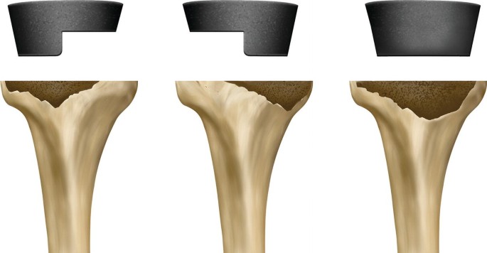 Total Knee Arthroplasty
