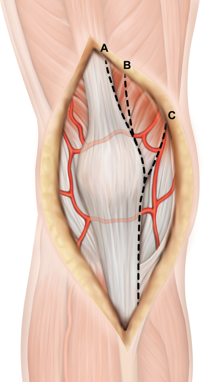 human biology - What are the coverings of femoral hernia? - Biology Stack  Exchange