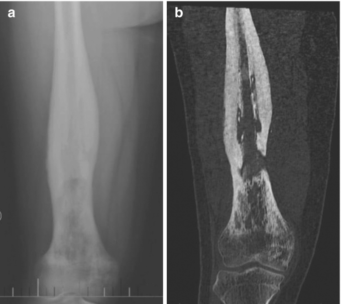 Thin shaft-rings from cattle-size tibia and metatarsus diaphyses.