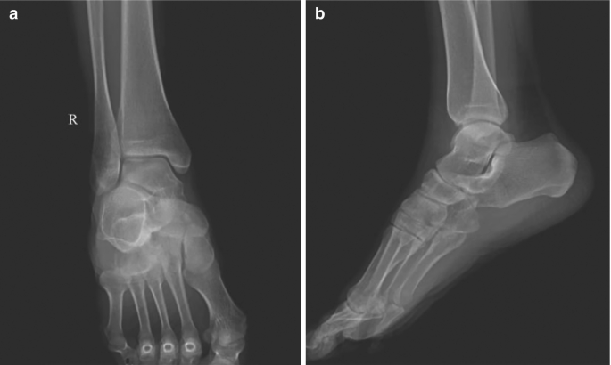 Peer overdraw loop Infectious Lesions in Bones and Joints | SpringerLink