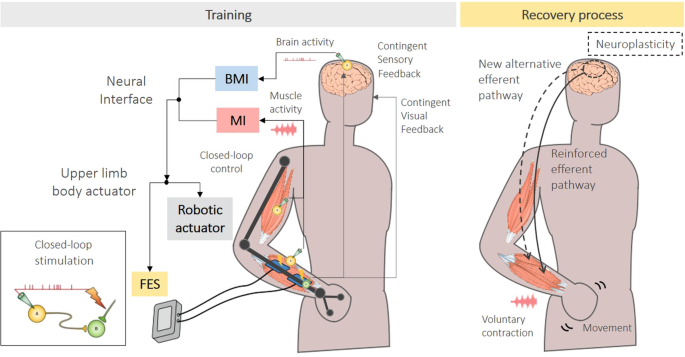 Neural Interfaces Involving the CNS and PNS Combined with Upper Limb  Actuators for Motor Rehabilitation After Stroke: Technical and Clinical  Considerations