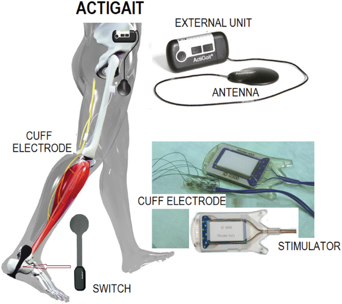 Functional electrical stimulation - Wikipedia