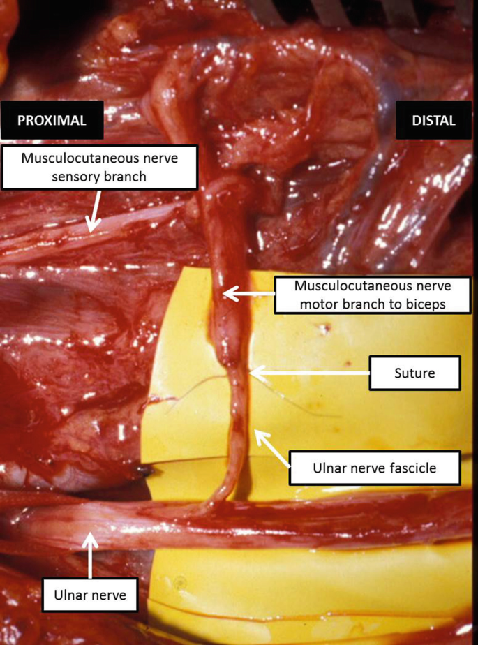 ASPN - Interfascicular Anatomy of the Motor Branch of the Ulnar Nerve: A  Cadaveric Study