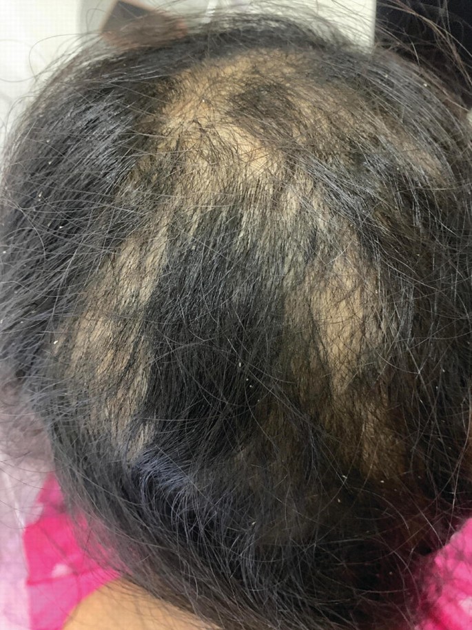 A photograph of a person with trichotillomania. Scarring hair loss with hair broken off at irregular lengths with coincidental pediculosis capitis is observed.