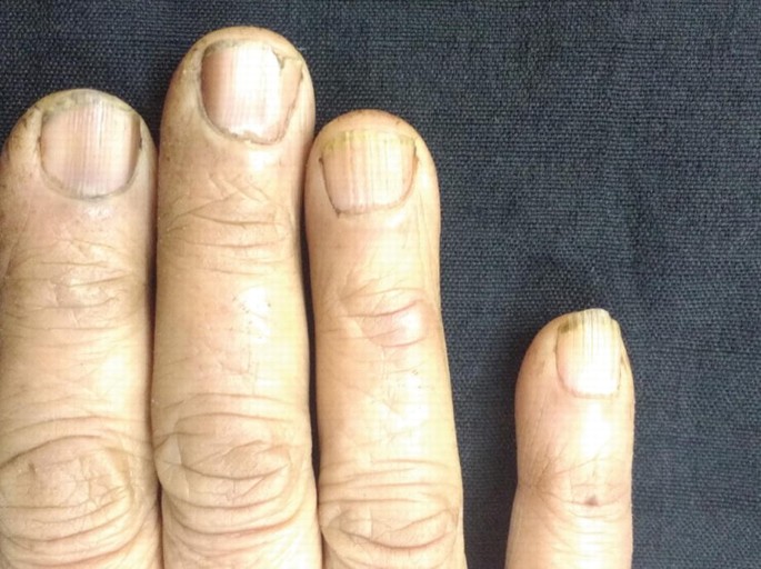 Finger nails to predict health