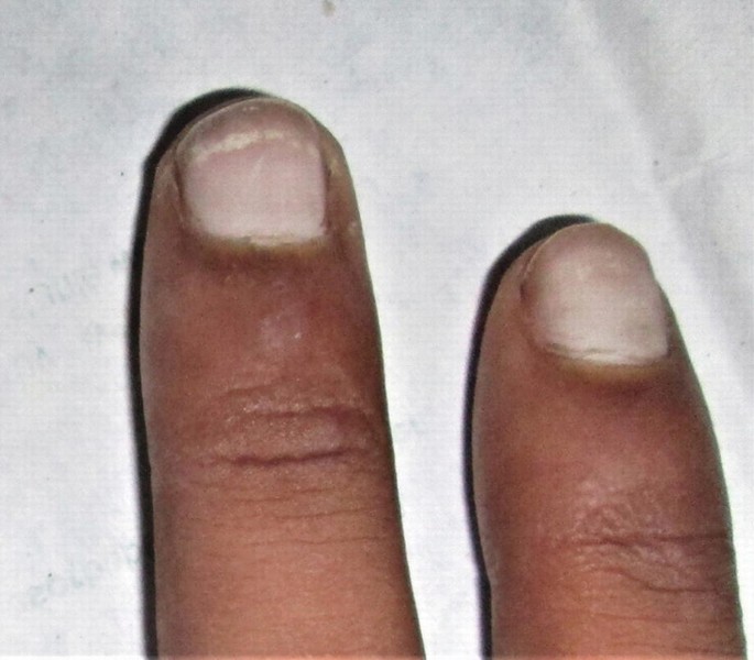 Nail Psoriasis Tips | MDedge Dermatology