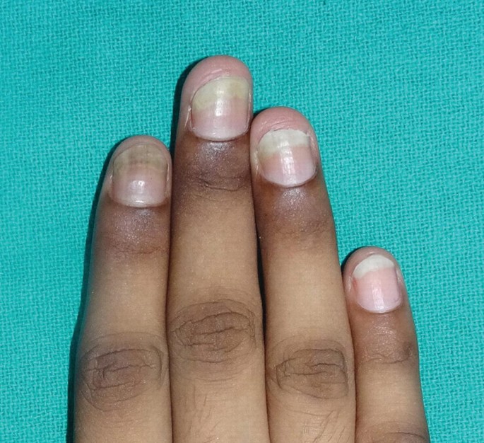 Gray-blue discoloration of the proximal nail beds