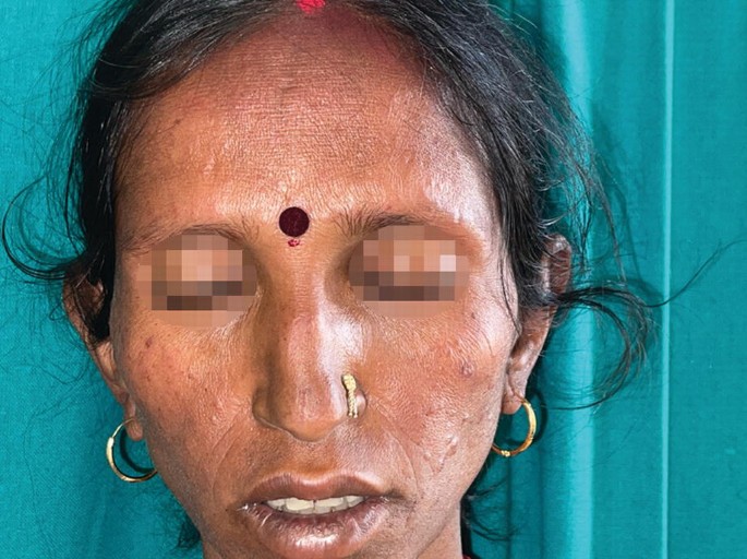 A photograph illustrates multiple nodular lesions and multiple papular lesions on the face of a female patient.