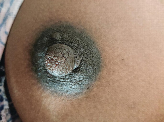 A photo of the breast of an individual. The area on and around the nipple is densely stained. The skin on the nipple is also fissured and has ridges. The nipple area is swollen.