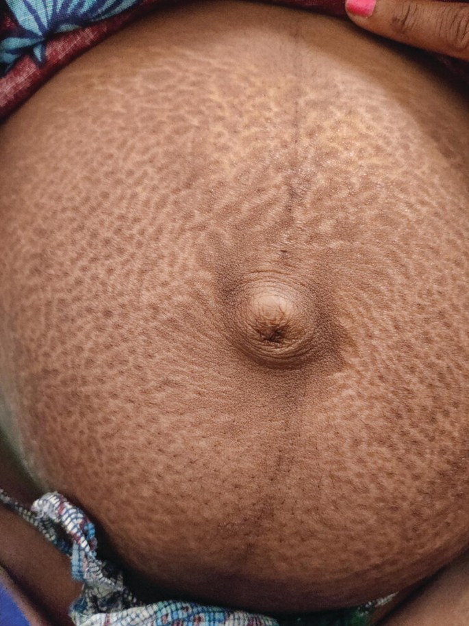 A photo of the abdomen of a pregnant lady. The area around the umbilicus is darkly stained, and patches of discoloration are distributed throughout the abdomen.