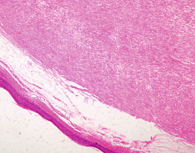Preneoplastic Lesions and Polyps of the Gastrointestinal ...