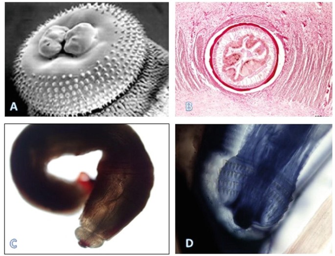 Gnathostomiasis Springerlink
