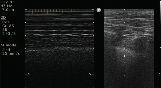 An ultrasound image of the lung. The horizontal lines in the image on the left are clear and sharp, while that in the image on the right is blurred and hazy.
