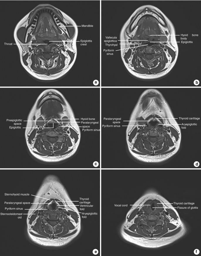 Imaging Anatomy of Larynx | SpringerLink
