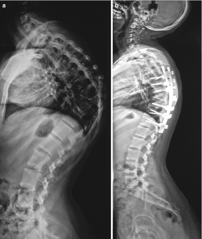 X-ray Dorso Lumbar Spine LAT View, Test Price in Delhi